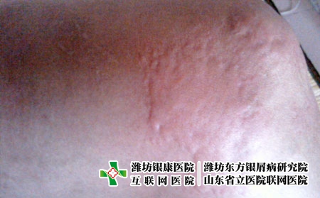 过敏可能引发的并发症，潍坊看皮肤病选潍坊银康