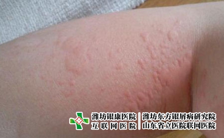 发生皮肤过敏怎么办，潍坊哪家医院治疗皮肤过敏怎么样