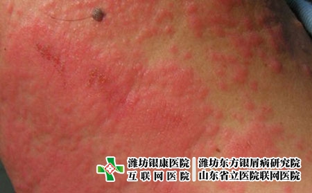 皮肤出现湿疹对患者的影响有哪些，湿疹有什么危害