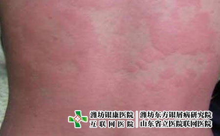 荨麻疹有哪些类型症状，荨麻疹有哪些