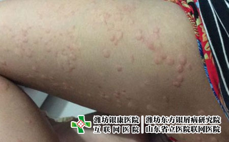 四肢荨麻疹的发病原因，胳膊老是起荨麻疹是为什么