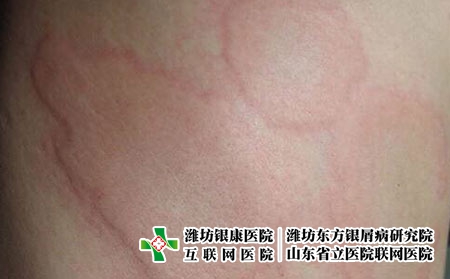 急性荨麻疹对我们的伤害，荨麻疹老反复有什么后果