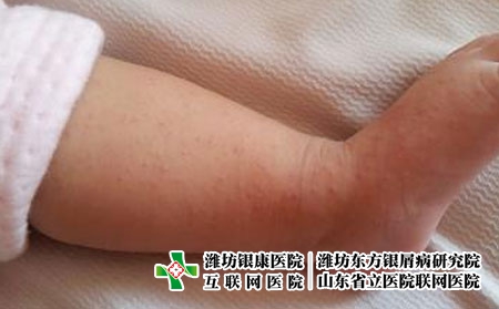 长期过敏具体会带给患者哪些危害，皮肤过敏后果严重吗