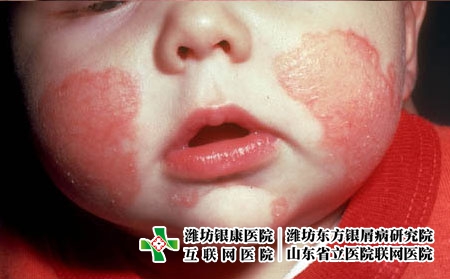 湿疹会导致什么样的症状，潍坊治湿疹哪个医院好?