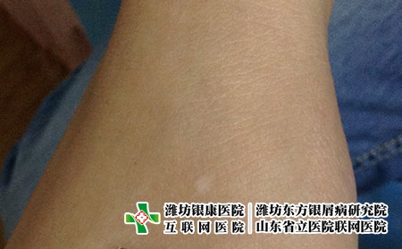 发展期的白癜风该如何控制，白癜风越来越多怎么办