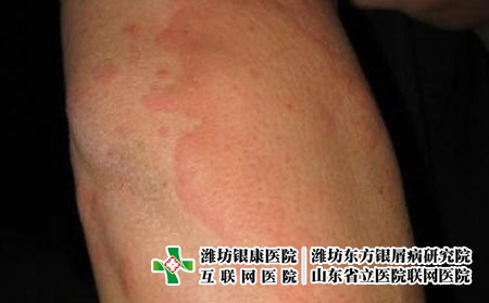 荨麻疹病人不该吃哪一类食品，长荨麻疹怎么忌口