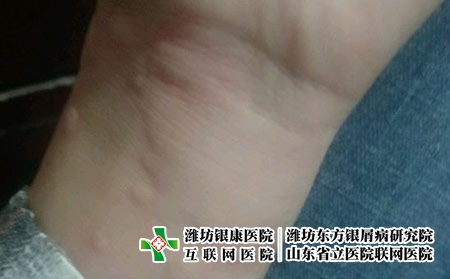 如何预防寒冷性荨麻疹，季节性荨麻疹能预防吗