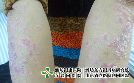 牛皮癣常见几点诱发原因是什么，什么会引起银屑病复发