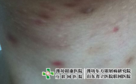 如何预防痤疮的出现，怎么避免痘痘反复