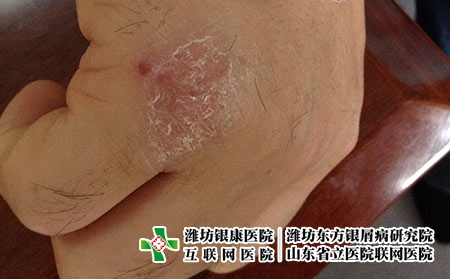 慢性湿疹怎么预防，老长湿疹平时要怎么做