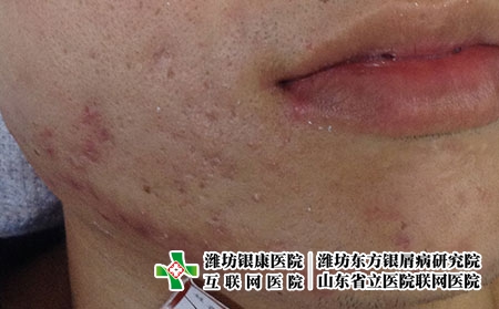 如何预防青春痘，长痤疮平时怎么护理