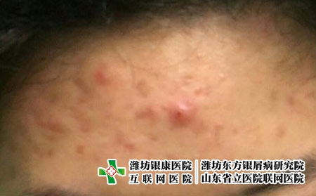 导致痤疮的原因有哪些，什么会引发痘痘