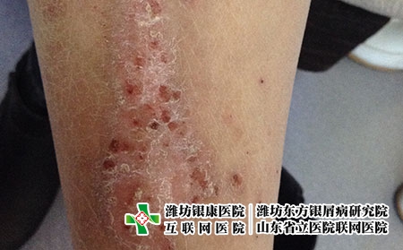 湿疹有哪些症状和表现，什么是湿疹