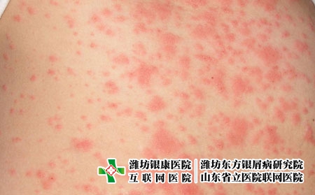 潍坊市治疗皮肤过敏要花多少钱?皮肤过敏治疗花钱多吗
