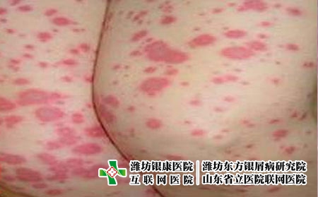 潍坊治疗皮肤过敏的医院哪家好，潍坊银康治皮肤过敏专业
