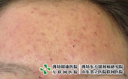 潍坊治疗皮肤过敏费用是多少，银康治皮肤过敏贵吗