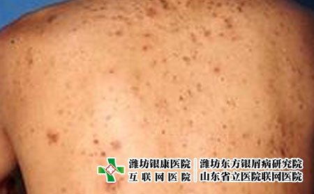 长痘痘了怎么办，爱长痤疮怎么护理