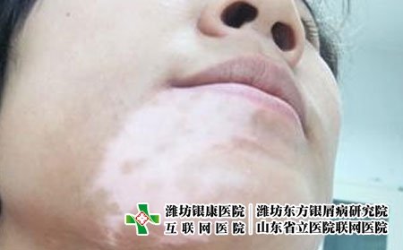 青春期患者得了白癜风后该如何治疗?白癜风如何科学诊治