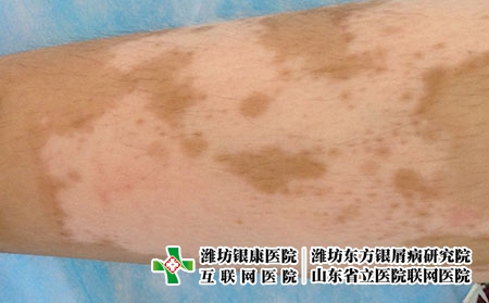 白癜风运动需要注意什么呢?长白癜风能锻炼身体吗
