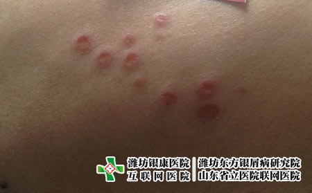 湿疹如何进行诊断，湿疹是什么样的