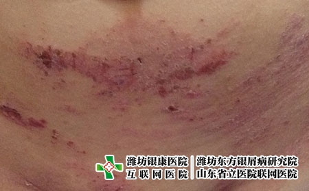 湿疹不治疗会怎么样，湿疹对人有什么影响