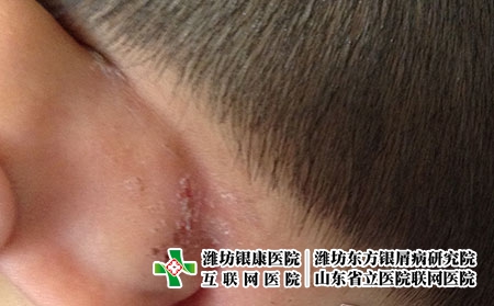 潍坊治疗湿疹大概费用是多少，银康治湿疹花多少钱