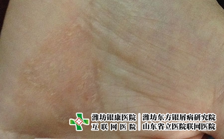 湿疹有哪些常见的症状表现，湿疹有多少种类