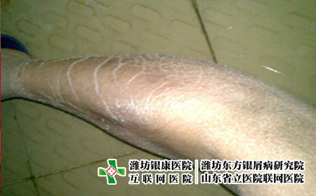 鱼鳞病是什么原因引起的?，为什么会得鱼鳞病