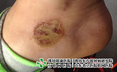 中老年湿疹是怎么回事，得了湿疹怎么办