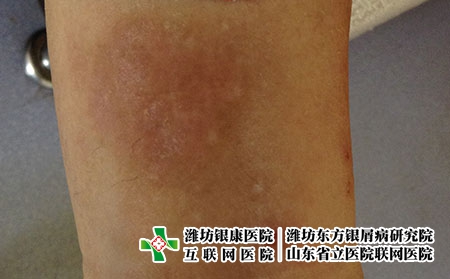 得了湿疹要怎么做，湿疹患者平时要怎么护肤