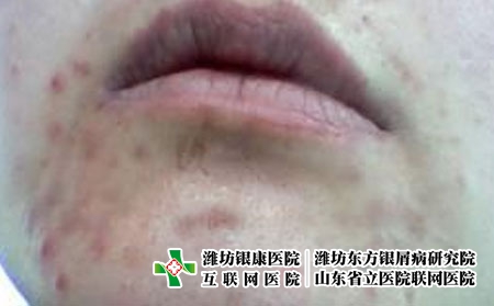 青春痘会有哪些临床症状，痤疮都有哪些种