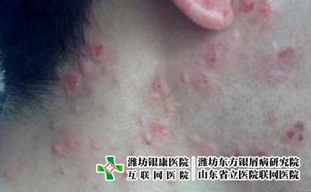 青春痘的诱因有哪些，为什么老长痤疮