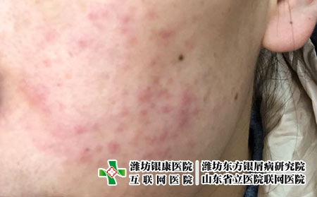 青春痘对患者来说会产生什么危害，痤疮有什么影响