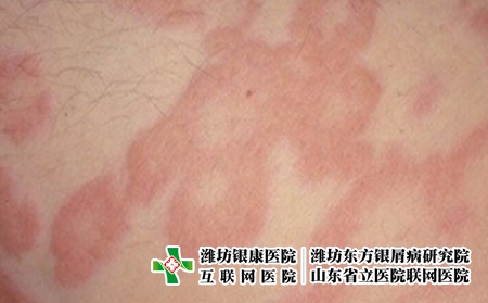决定过敏性皮炎治疗费用的几大因素，治皮炎要多少钱