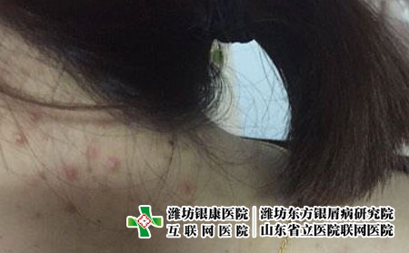 长青春痘要注意什么-潍坊医院看青春痘怎么样
