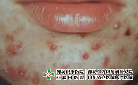 常见的痘痘类型有哪些?潍坊治青春痘，可以选择潍坊银康皮肤病医院!