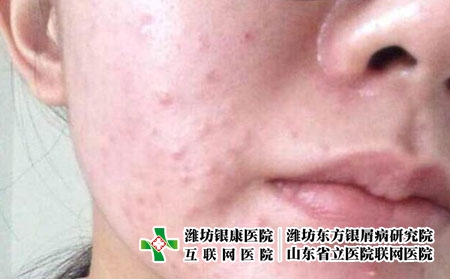 潍坊哪个医院治疗青春痘效果较好?嘴巴周围长痘痘的原因是什么?