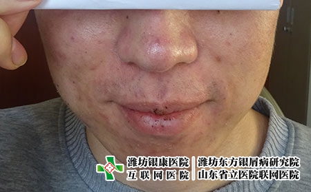 痤疮严重了有什么后果-潍坊哪家医院治疗青春痘好?
