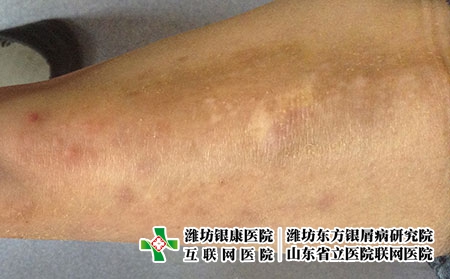 湿疹的护理有哪些-潍坊治疗湿疹的好医院看银康