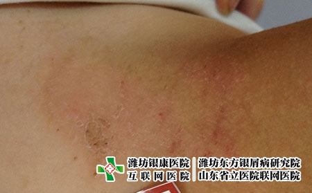 湿疹要注意什么-潍坊哪所医院治疗湿疹好?