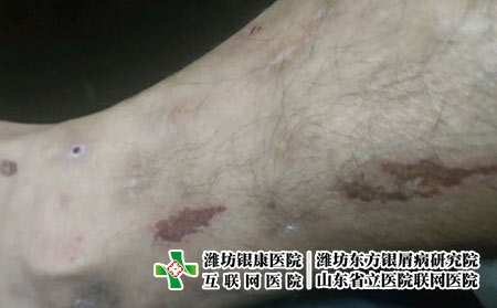 过敏性皮炎有什么症状-潍坊治疗皮炎比较好的医院?