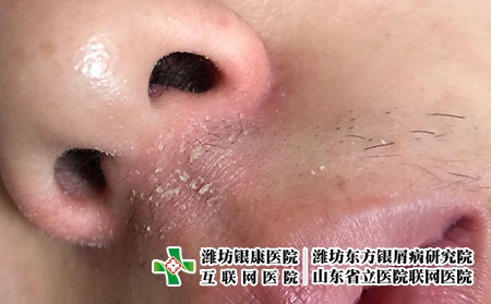 面部脂溢性皮炎的症状是什么样的，潍坊哪个医院看脂溢性皮炎?
