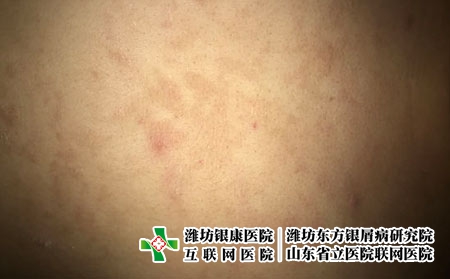 得皮炎时会有哪些症状?潍坊治疗皮炎，可以选择潍坊银康皮肤病医院!