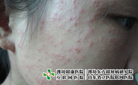嘴巴周围长痘痘的原因是什么?潍坊哪个医院治疗青春痘效果较好?
