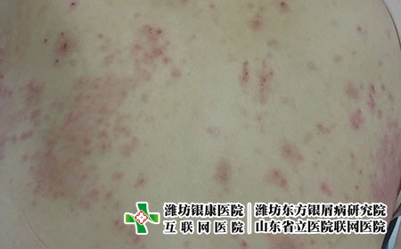 湿疹的诱因，潍坊去哪儿看湿疹问银康