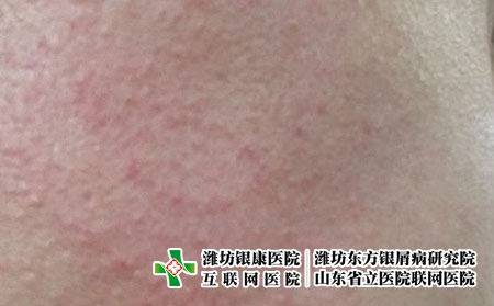 皮炎发生时应该注意什么