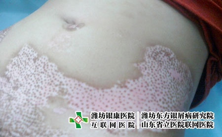 早期是治疗白癜风的好阶段吗?