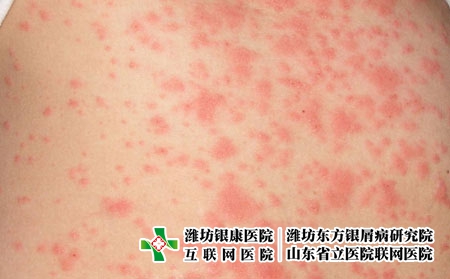 潍坊生活中皮肤瘙痒患者的护理措施有哪些
