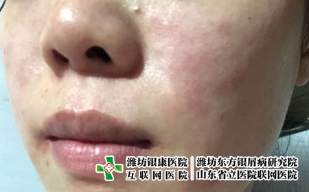 什么是接触性皮炎