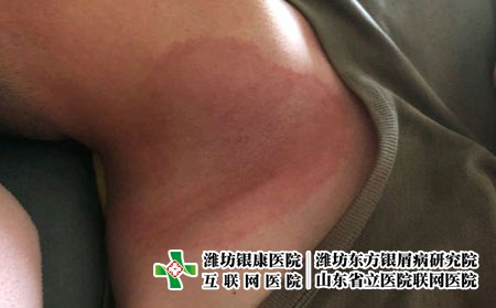 脂溢性皮炎患者做些什么好